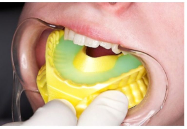 FLUORIDE APPLICATION DR SREEJITH V P , DENTAL (Oral & Maxillo Facial